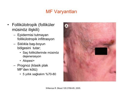 Yavaş Seyirli Cilt Lenfomaları - Lenfoma Myeloma Derneği