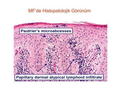 Yavaş Seyirli Cilt Lenfomaları - Lenfoma Myeloma Derneği