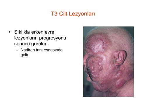 Yavaş Seyirli Cilt Lenfomaları - Lenfoma Myeloma Derneği