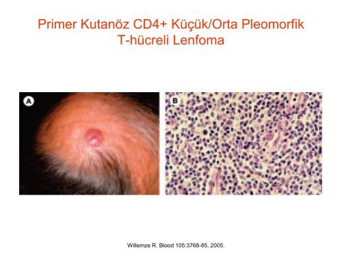 Yavaş Seyirli Cilt Lenfomaları - Lenfoma Myeloma Derneği