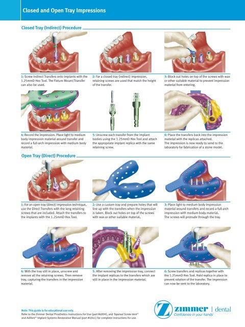 Closed and Open Tray Impressions - Zimmer Dental