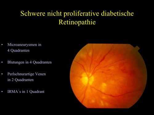 Diabetische Retinopathie