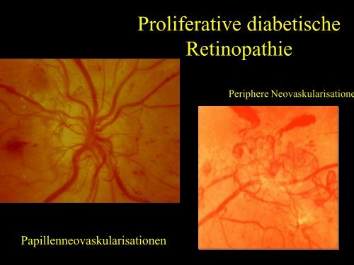 Diabetische Retinopathie