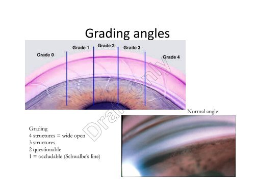 Gonioscopic Evaluation of the Anterior Chamber Angle