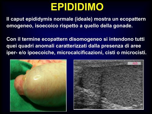 Inquadramento nosografico e indagini dell'azoospermia