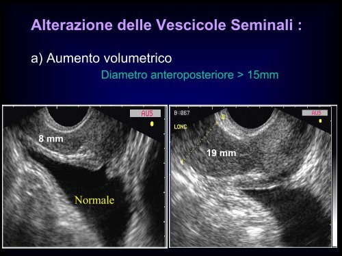 Inquadramento nosografico e indagini dell'azoospermia