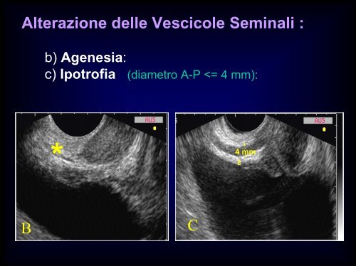 Inquadramento nosografico e indagini dell'azoospermia