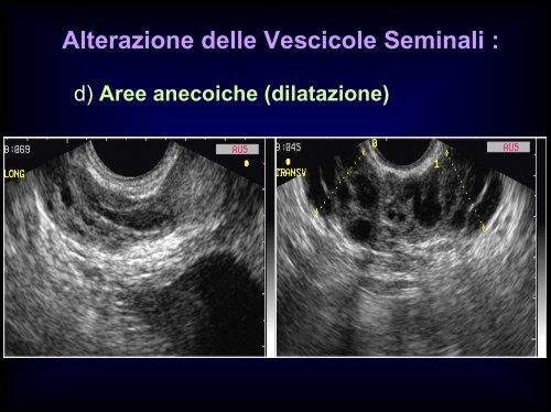 Inquadramento nosografico e indagini dell'azoospermia