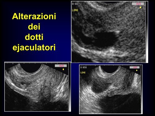 Inquadramento nosografico e indagini dell'azoospermia