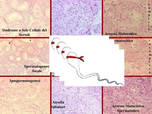 Inquadramento nosografico e indagini dell'azoospermia