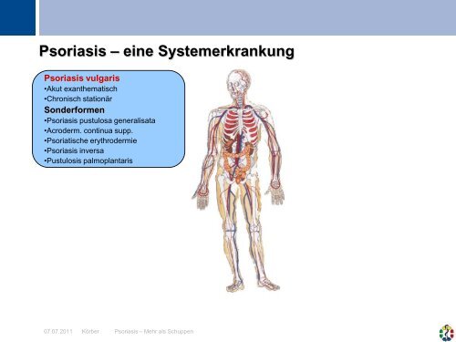 Psoriasis - Universitätsklinikum Essen