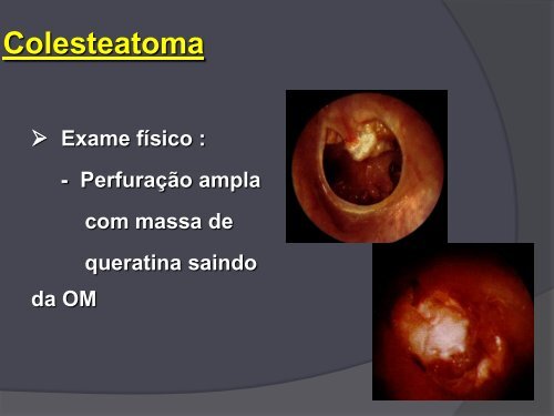 Otites Médias Cronicas.pdf - Webnode