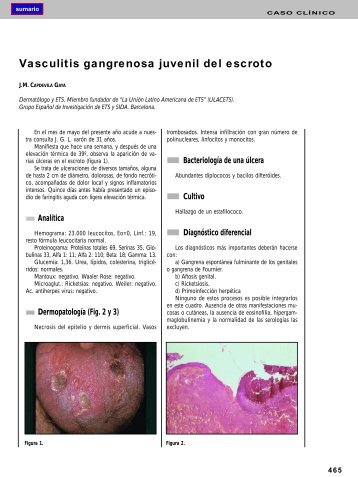 Vasculitis gangrenosa juvenil del escroto