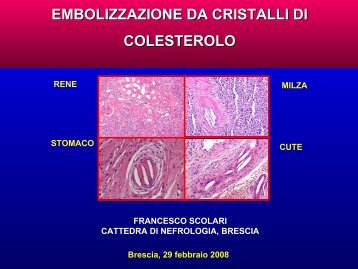 EMBOLIZZAZIONE DA CRISTALLI DI COLESTEROLO - GrG