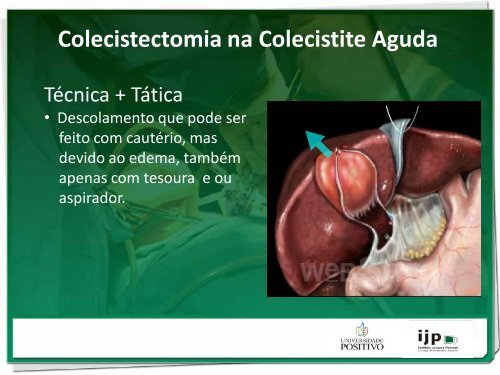 Colecistectomia na Colecistite Aguda TRUQUES E DICAS - IJP