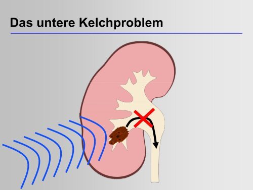 Moderne Steintherapie - Universitätsklinik für Urologie in Tübingen