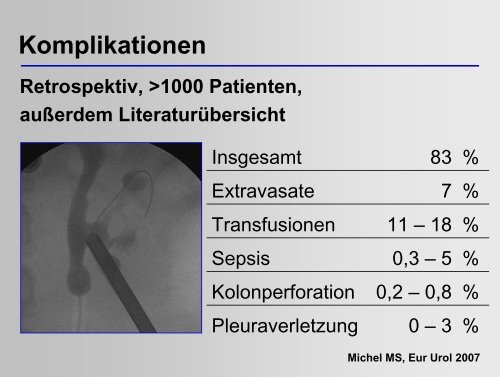 Moderne Steintherapie - Universitätsklinik für Urologie in Tübingen