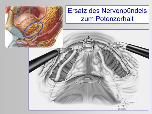 10 Jahre roboterassistierte Chirurgie - Universitätsklinik für Urologie ...