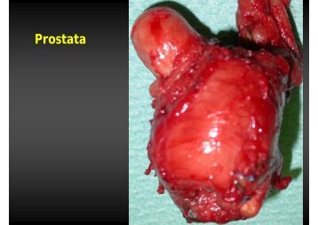 Einführung in die Urologie und Prostata CA