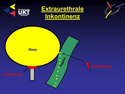 Harninkontinenz - Universitätsklinik für Urologie in Tübingen