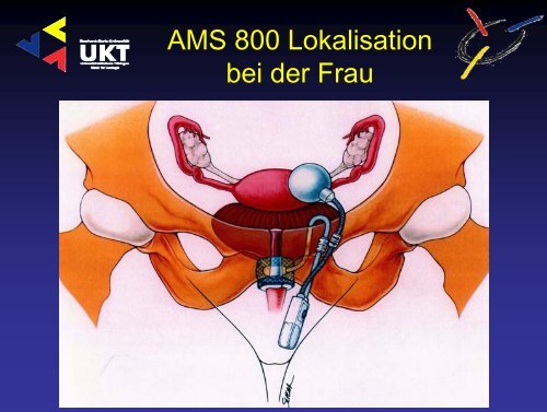 Harninkontinenz - Universitätsklinik für Urologie in Tübingen