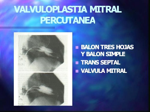 Valvuloplastia - Cardiología Clínica El Salvador