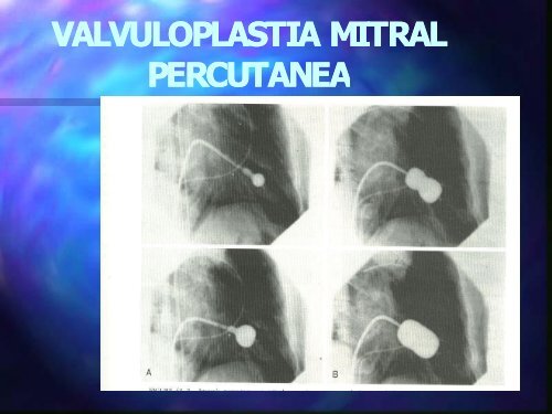 Valvuloplastia - Cardiología Clínica El Salvador