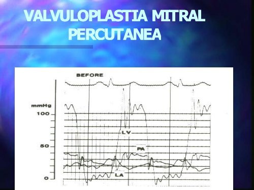 Valvuloplastia - Cardiología Clínica El Salvador