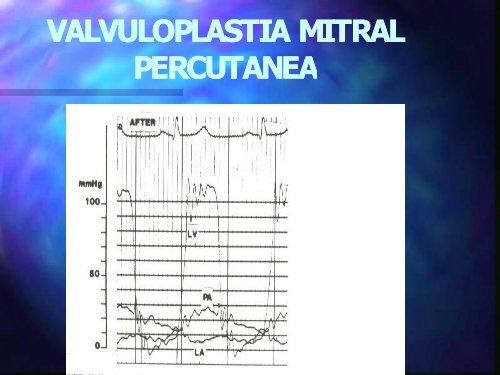 Valvuloplastia - Cardiología Clínica El Salvador