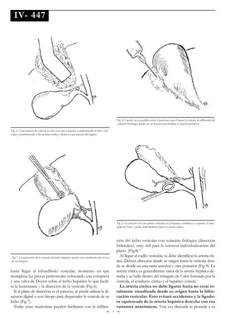 Colecistectomía típica y atípica por vía convencional. - Sacd.org.ar