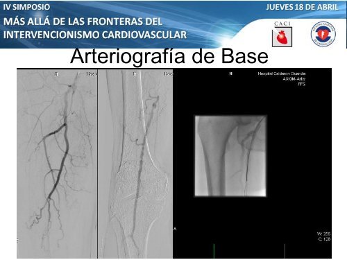 Anterógrado o retrógrado? - CACI