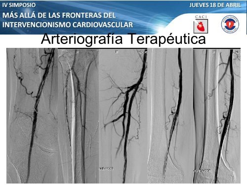 Anterógrado o retrógrado? - CACI