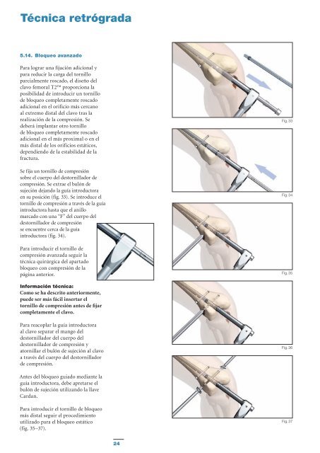 Técnica anterógrada - quirofano de Trauma