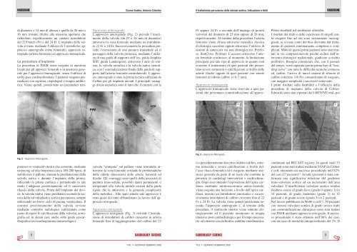 Il trattamento percutaneo della stenosi aortica. Indicazione e ... - sicoa