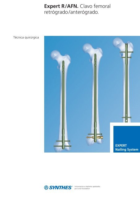 Expert R/AFN. Clavo femoral retrógrado /anterógrado. - Synthes