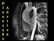 Aula Dissecção Aguda de Aorta - Dr. Jairo - Univasf