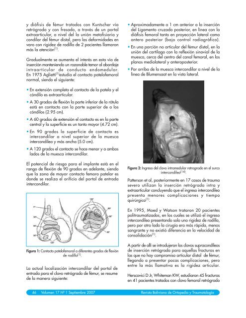 CLAVO ENDOMEDULAR DE TIBIA EN EL TRATAMIENTO DE ...