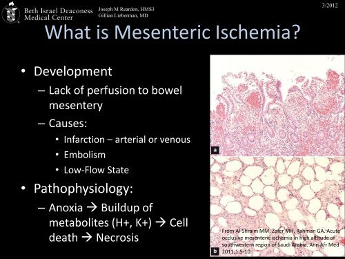 Mesenteric Ischemia: Silent Killer - Lieberman's eRadiology ...