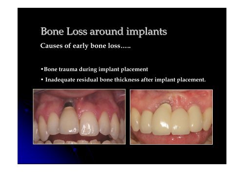 Implants and Periodontal Disease - Oxford Deanery