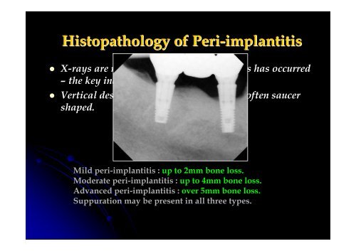 Implants and Periodontal Disease - Oxford Deanery