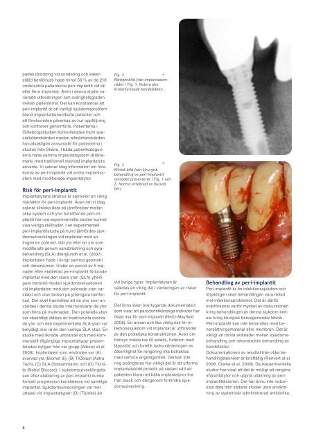 Tema: Peri-implantitis - Zendium tandpasta