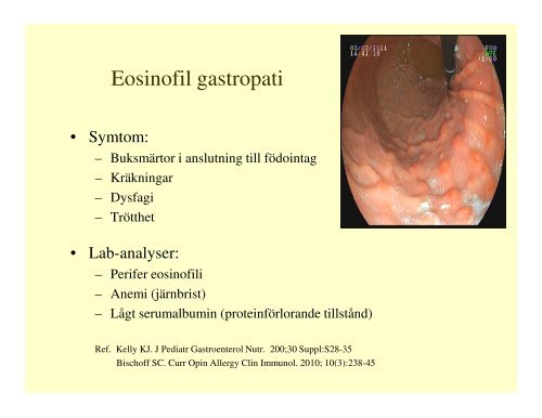 (Microsoft PowerPoint - \305h\366rarkopior Eosinofil esofagit ...