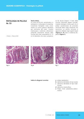 Adenoma dentellato di tipo sessile