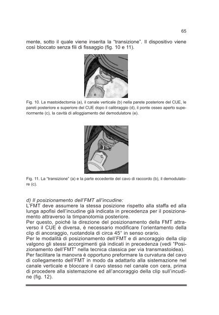 Tiroidectomia Totale: How I do it - AOOI