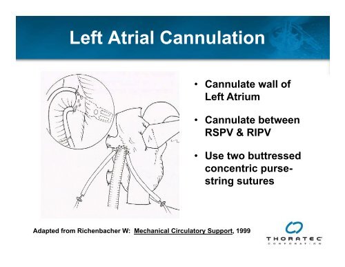 View CentriMag Magnetically Levitated Circulatory Support System