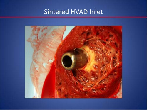 Emerging LVAD Technology for the Use - Washington Hospital Center