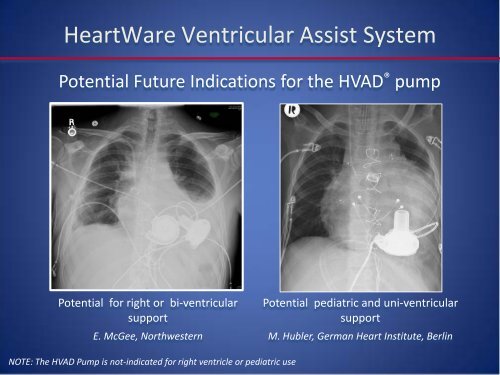 Emerging LVAD Technology for the Use - Washington Hospital Center