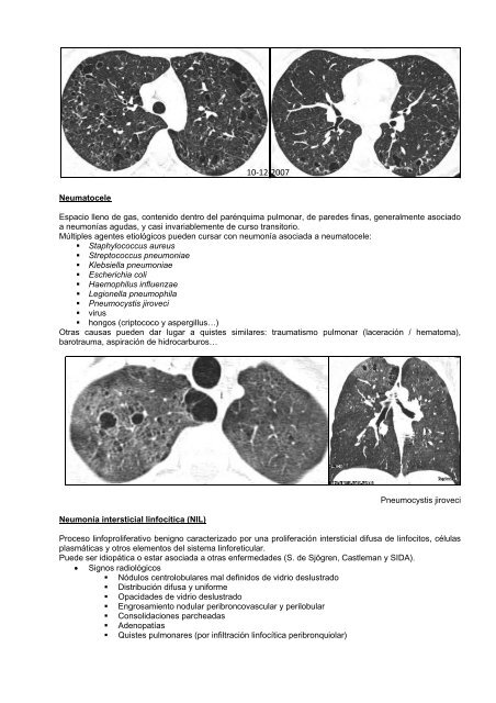 ENFERMEDAD PULMONAR OBSTRUCTIVA CRÓNICA D.D. ...