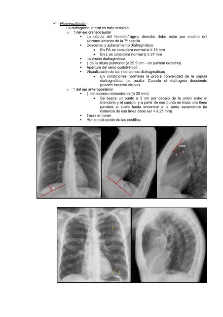 ENFERMEDAD PULMONAR OBSTRUCTIVA CRÓNICA D.D. ...