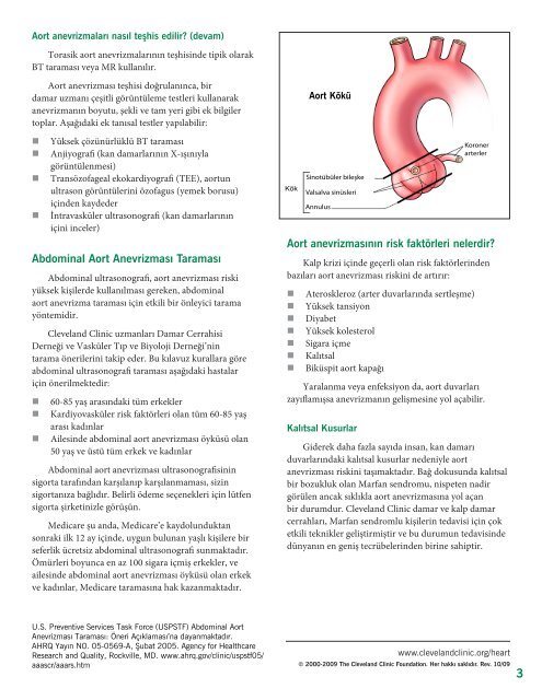 Aort Anevrizması Kılavuzu - Cleveland Clinic